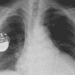 Pacemaker