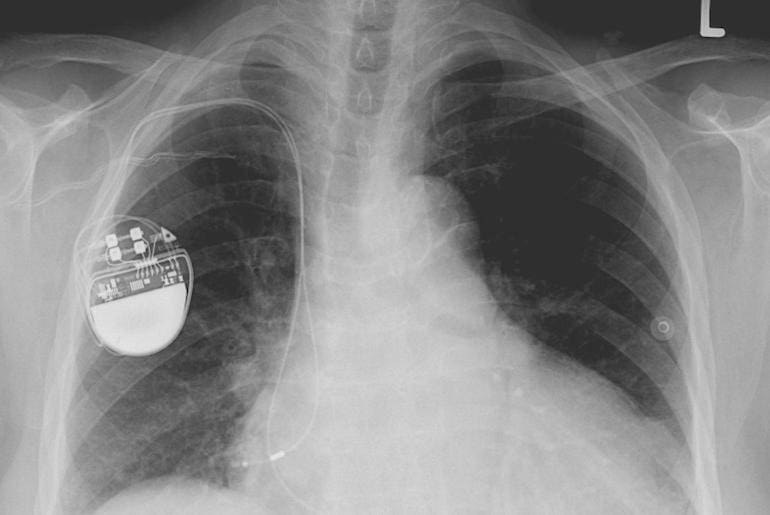 Pacemaker