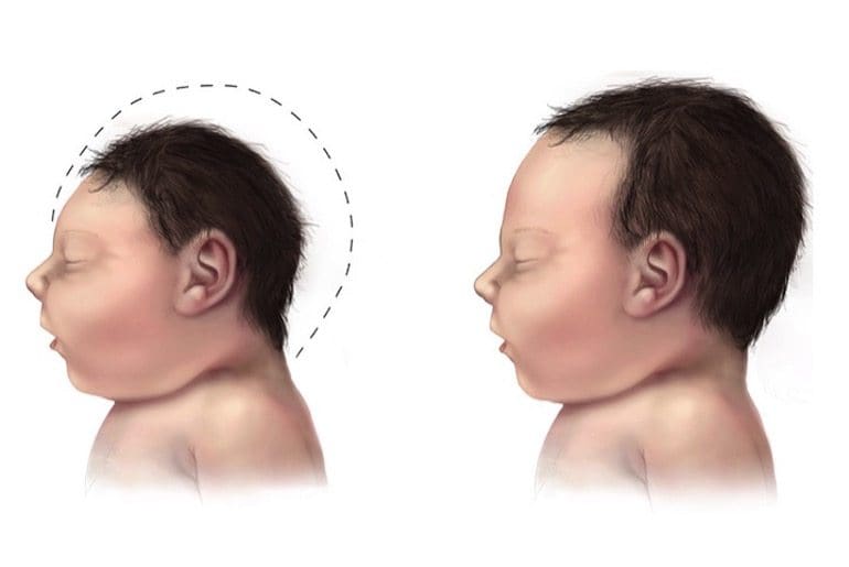 Microcephaly