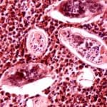 Schistosomiasis inequality