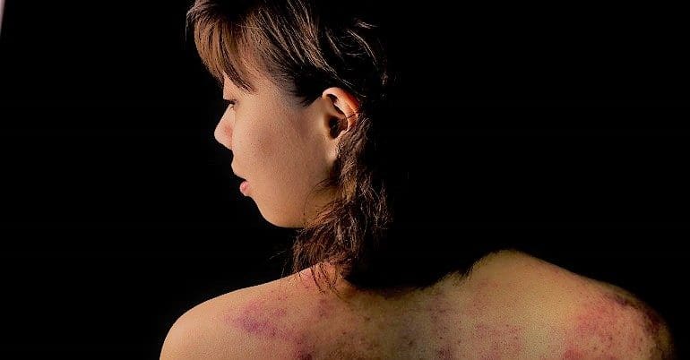 Women- bruises