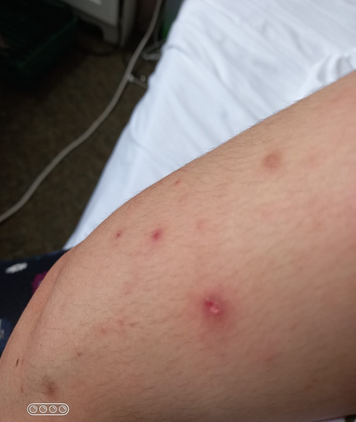 Insect bites on one of the children 