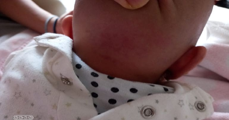 Skin irritation on the back of a baby's head