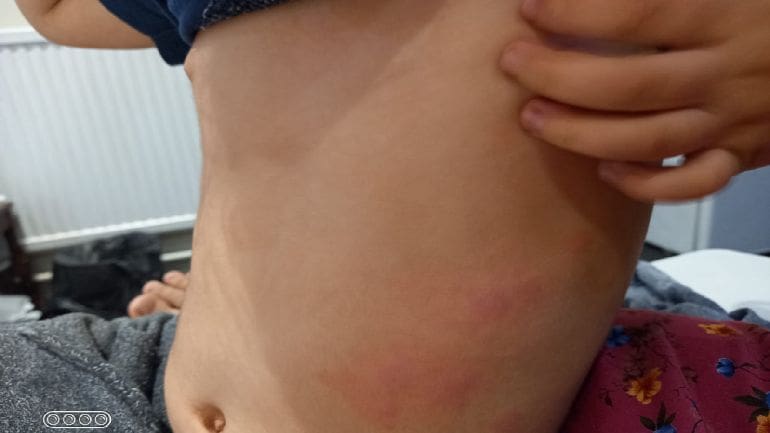Skin irritation from insect bites in a Home Office Hotel 