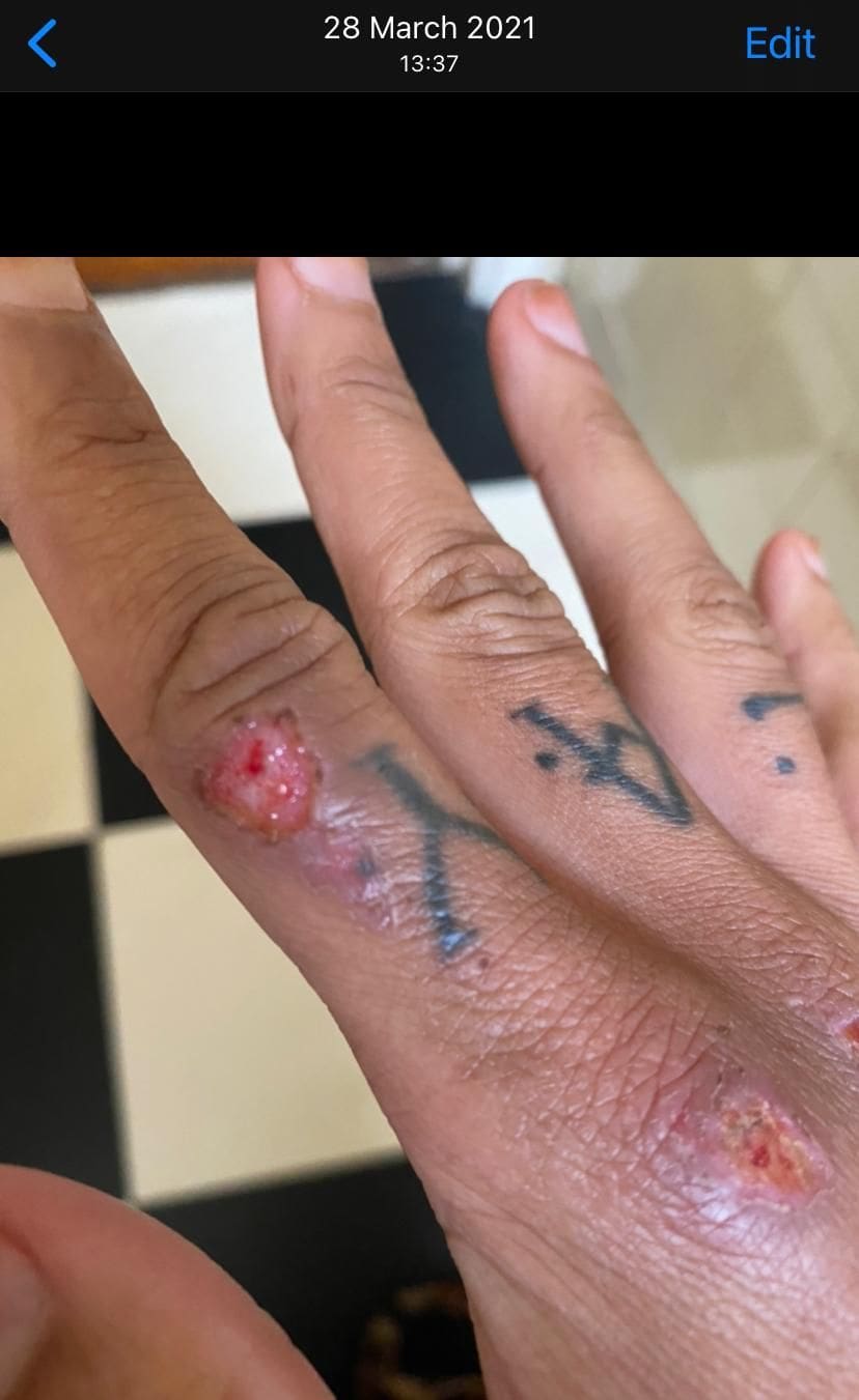 Injuries to Mariella's hand 