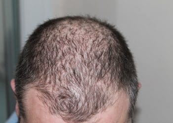 Tips On Supporting Your Husband Through Hair Loss