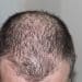 Tips On Supporting Your Husband Through Hair Loss
