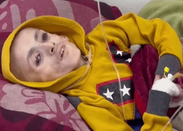 A starving child in Gaza Israel