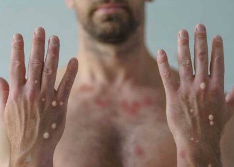 mpox