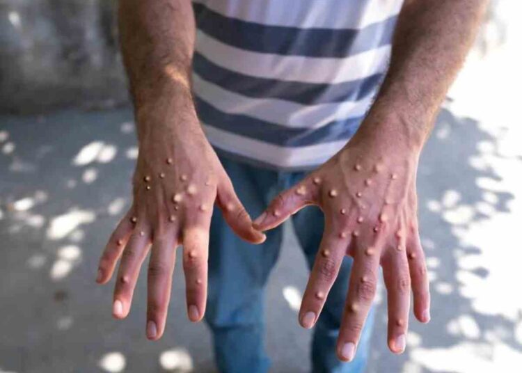 Mpox