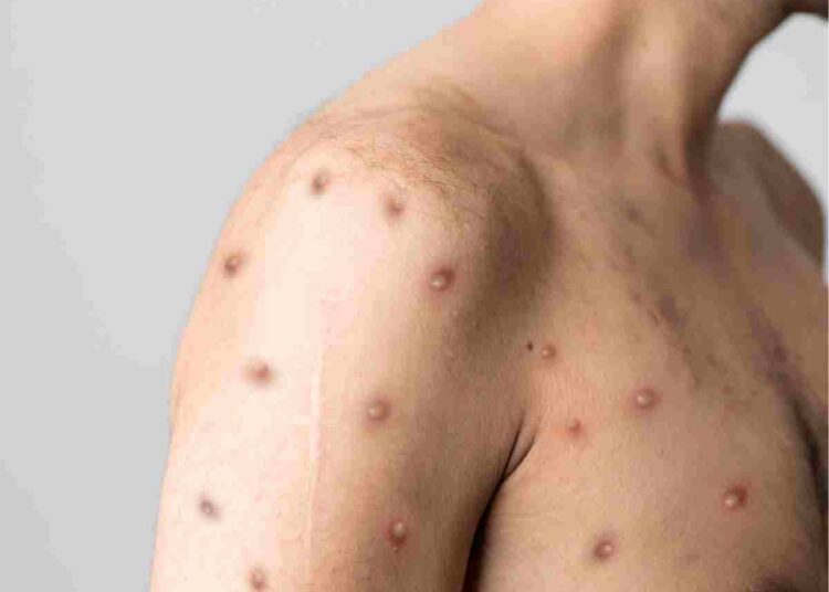 Mpox London clade 1b