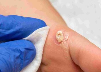 warts treatment uk