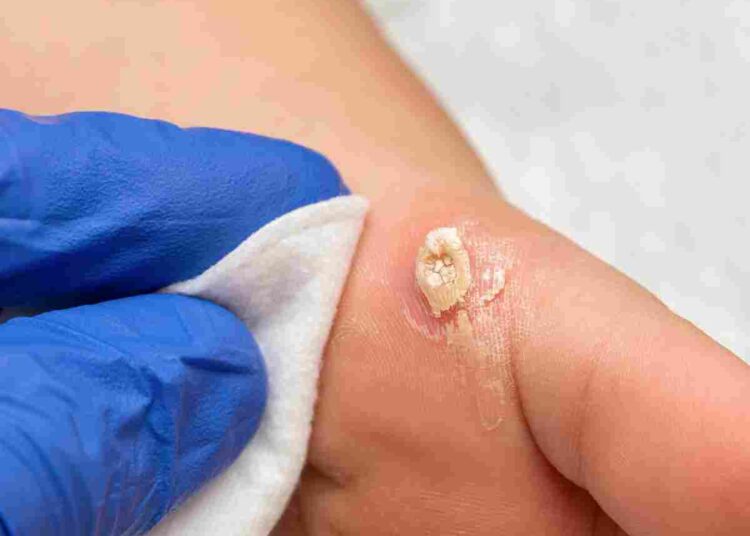 warts treatment uk