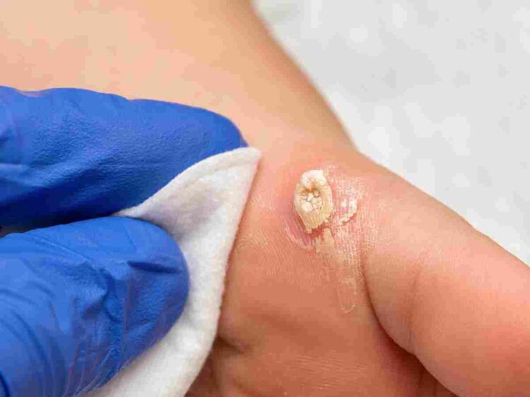 warts treatment uk