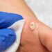 warts treatment uk