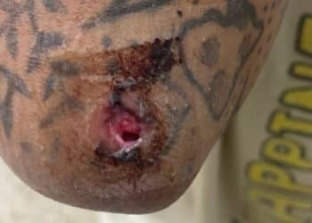 A bloody wound on a tattooed limb following an attack by Israeli settlers in Ramallah