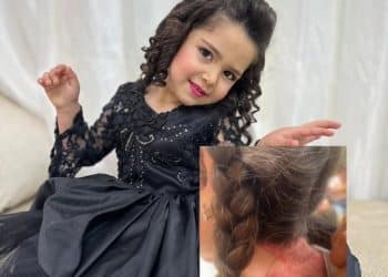 A Pain that cameras cannot see. Al-Baz witnessed a child burning twice