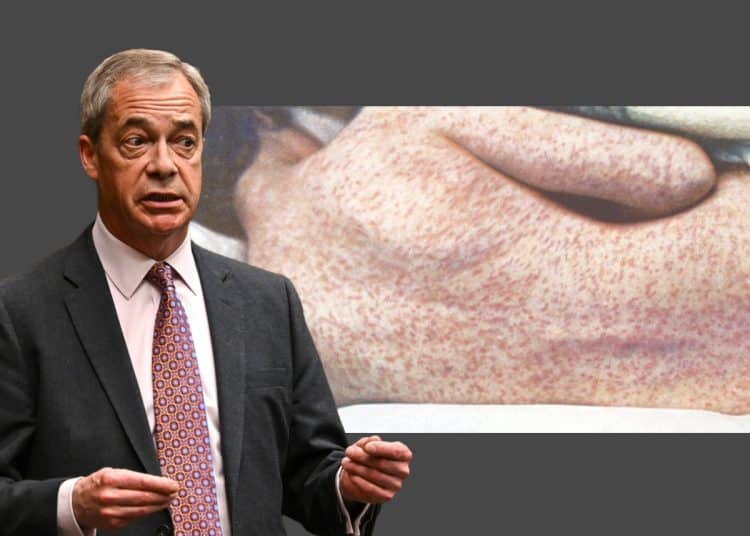Nigel Farage and a person suffering from measles