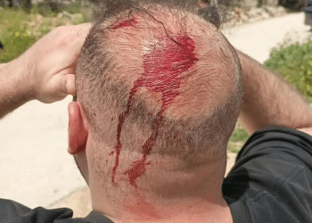 Blood stains mark the back of a Palestinian man's head having been subjected to Israeli settler violence in March 2026