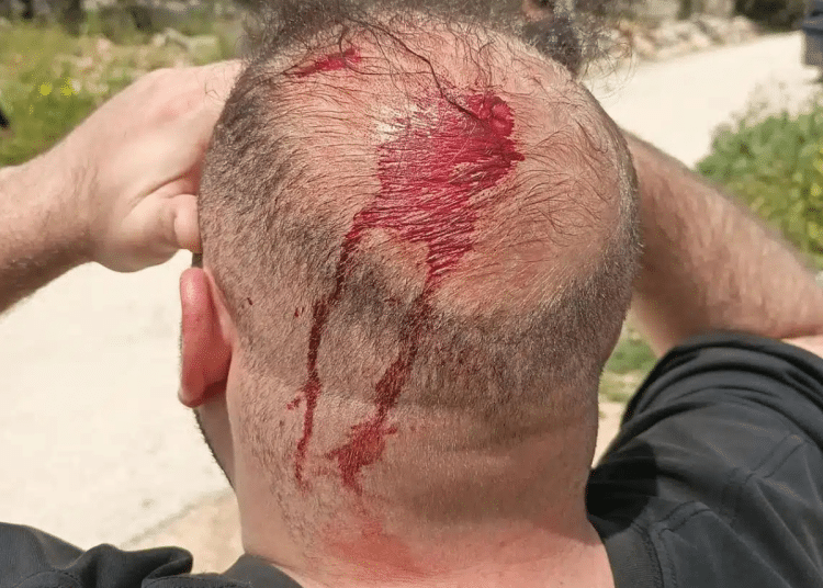 Blood stains mark the back of a Palestinian man's head having been subjected to Israeli settler violence in March 2026