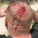 Blood stains mark the back of a Palestinian man's head having been subjected to Israeli settler violence in March 2026