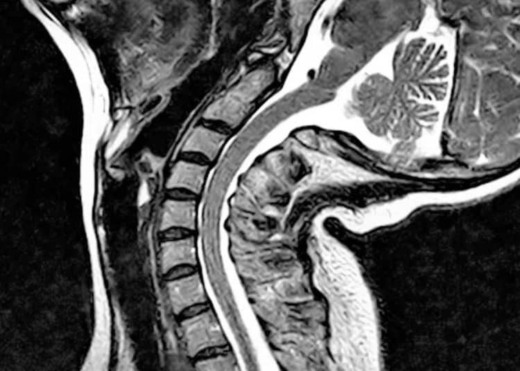 EDS spine
