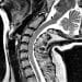 EDS spine