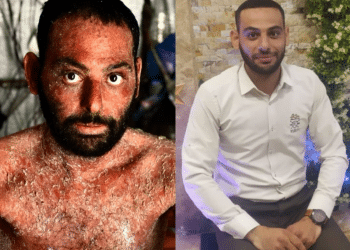 Ibrahim Abu Aram, from Gaza, had vulgar pemphigus disease. On the left is a photo of him bare chested and his skin is red raw, scaly and looks sore. On the right, he is dressed in a smart shirt and smiling. There's no sign of his skin disease.