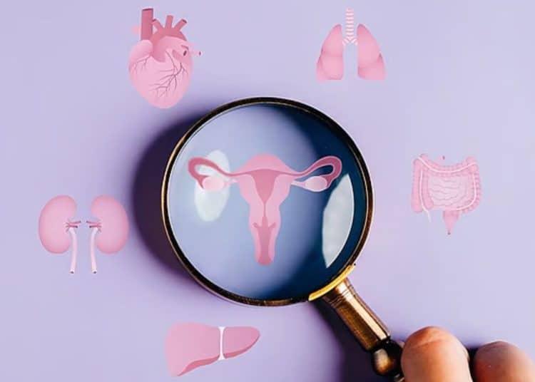 PCOS