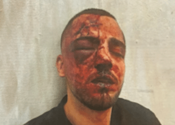 Saleh Khalil Faisal Na’ama in Israel. His face is red with darkened blood and his right eye swollen shut